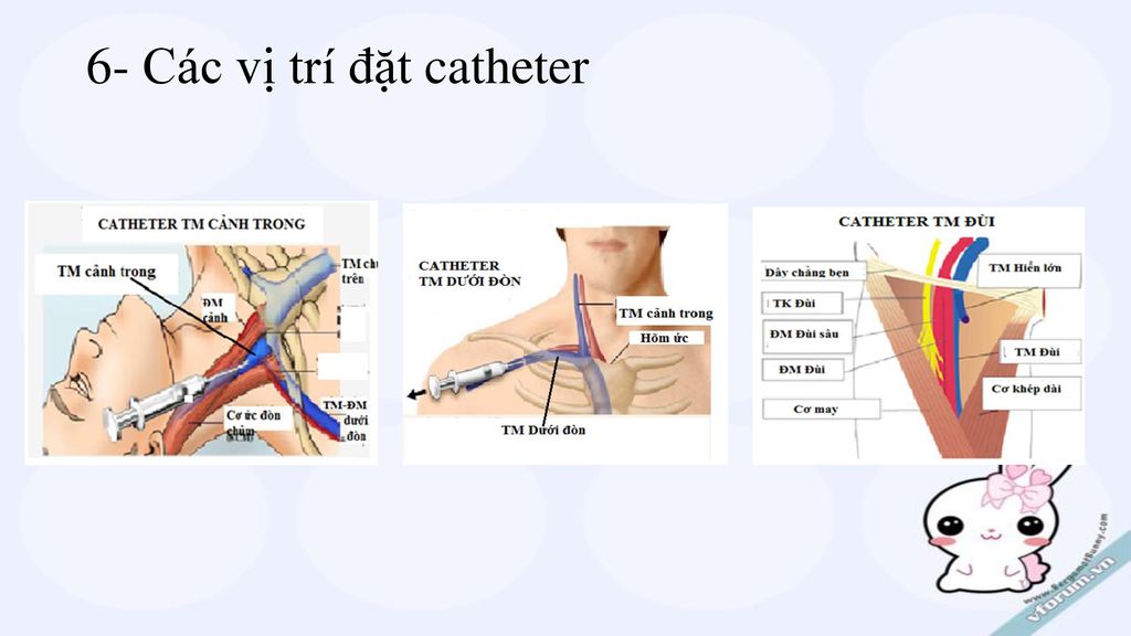 6- Các vị trí đặt catheter