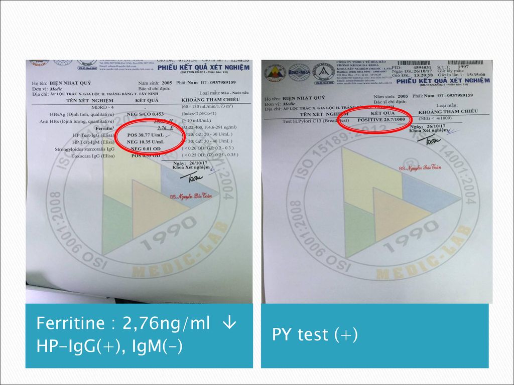 Ferritine : 2,76ng/ml  HP-IgG(+), IgM(-) PY test (+)