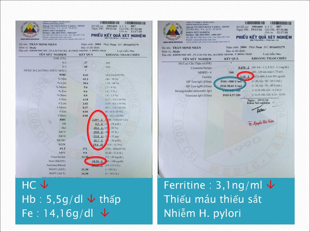 HC  Hb : 5,5g/dl  thấp. Fe : 14,16g/dl  Ferritine : 3,1ng/ml  Thiếu máu thiếu sắt.