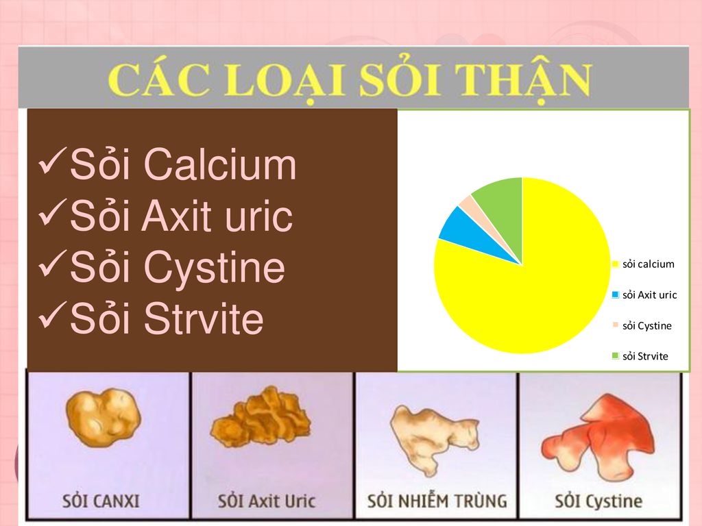 Sỏi Calcium Sỏi Axit uric Sỏi Cystine Sỏi Strvite