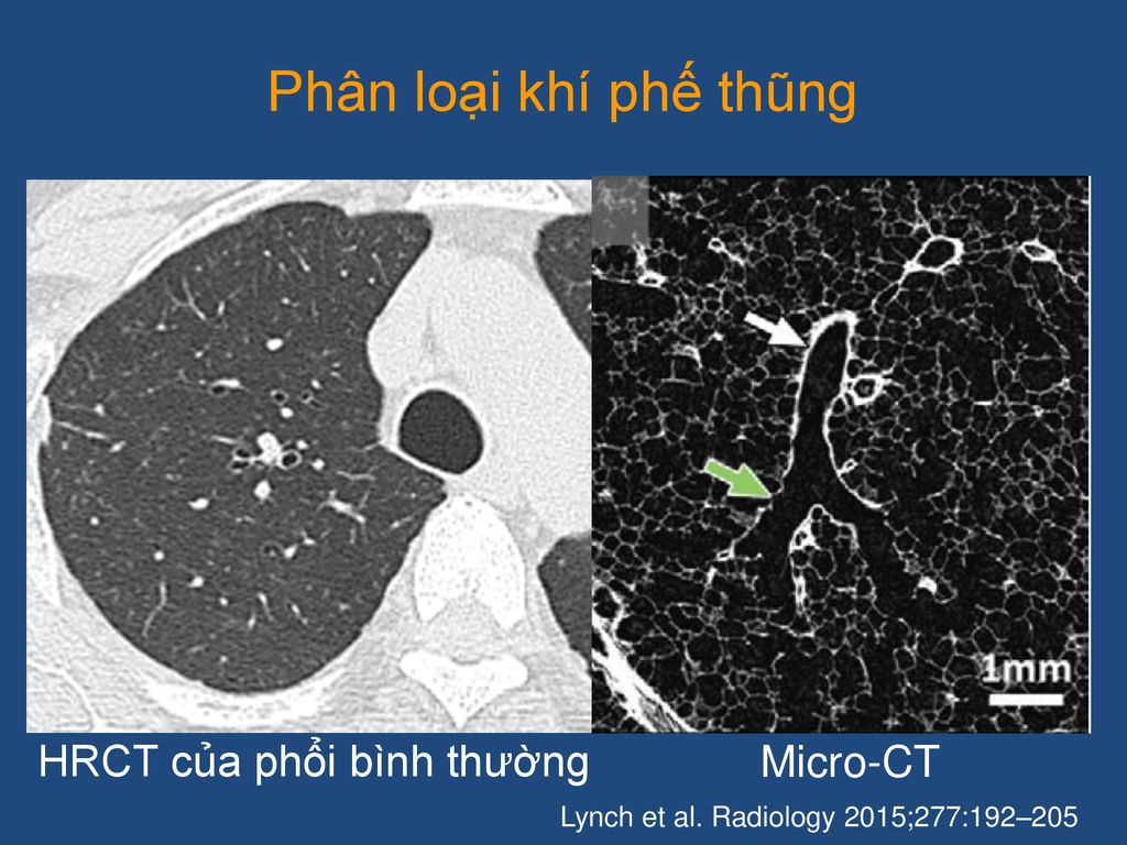 Phân loại khí phế thũng HRCT của phổi bình thường Micro-CT
