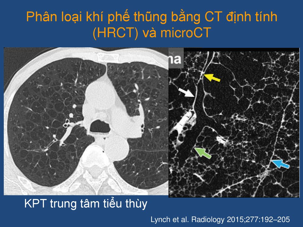 Phân loại khí phế thũng bằng CT định tính (HRCT) và microCT