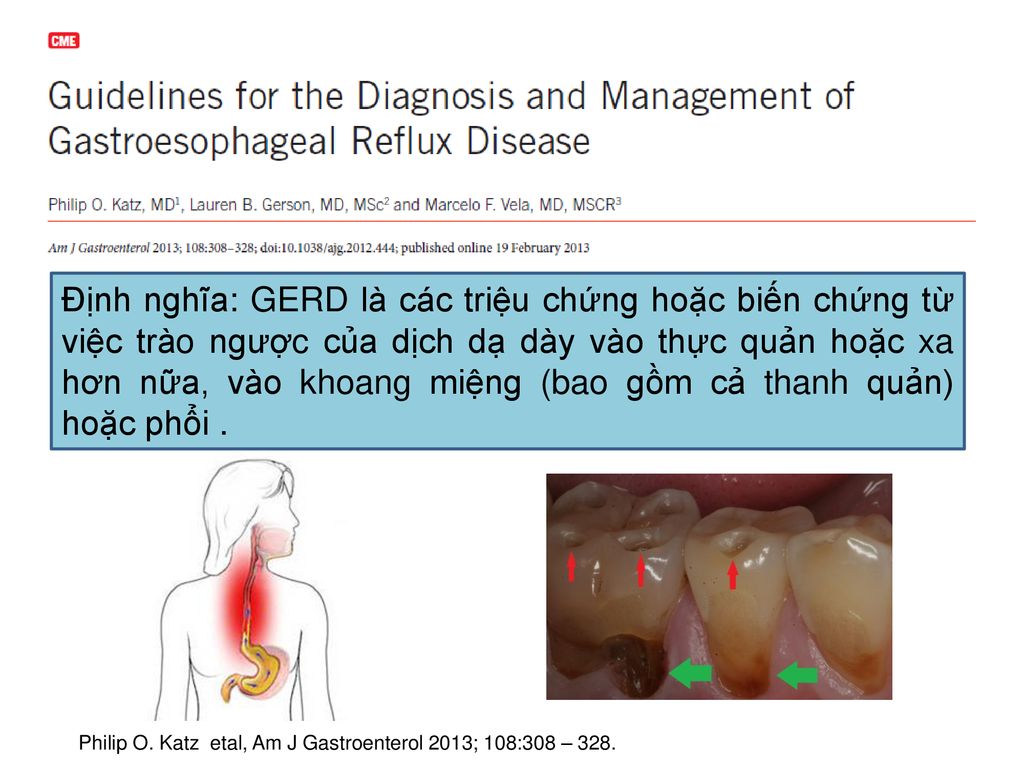 Định nghĩa: GERD là các triệu chứng hoặc biến chứng từ việc trào ngược của dịch dạ dày vào thực quản hoặc xa hơn nữa, vào khoang miệng (bao gồm cả thanh quản) hoặc phổi .